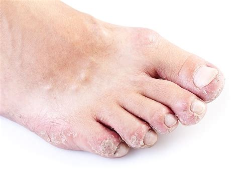 Eczema Atopic Dermatitis Symptoms Causes Treatment And Photos
