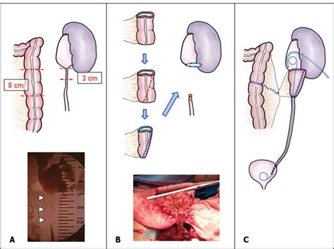 Upper Ureteral Reconstruction With A Tapered Segment Of Descending Download Scientific Diagram