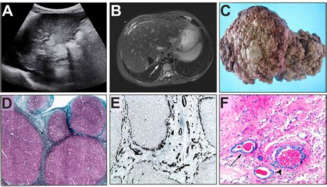 Cystic Fibrosis Related Liver Disease Clinical Presentations