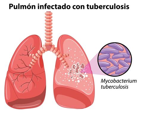 Guía De Tuberculosis Aurora Health Care