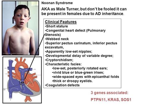 Pictures Of Babies With Noonan Syndrome