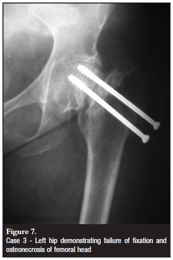 Subcapital Femoral Neck Fracture In Patients With Hiv And Osteonecrosis