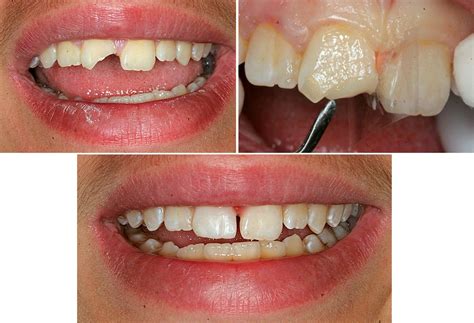 Treatment for a chipped or broken tooth will depend on the severity of the damage. glue-to-fix-chipped-teeth - Kuipers Ortho