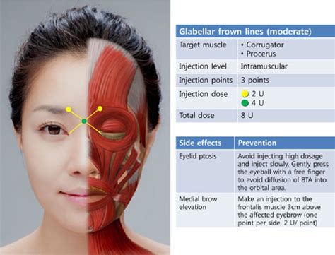 Masseter Hypertrophy Toxin Treatment Techniques Causes Of Complications