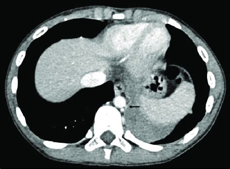 Torsion Of Extralobar Pulmonary Sequestration In A 10 Year Old Boy On