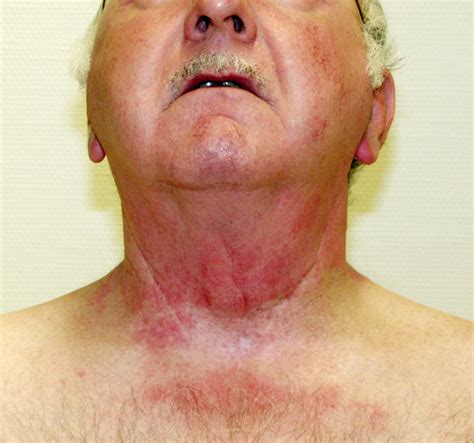 Enhanced Radiation Sensitivity And Radiation Recall Dermatitis Rrd