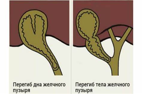 Диета перегиб желчного