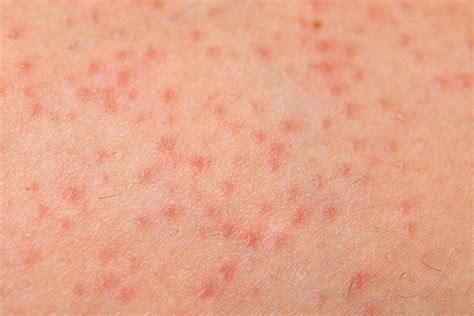 20 Different Causes Of Rashes In Babies And Their Prevention