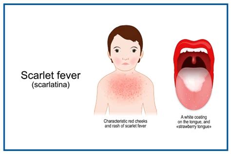 Scarlet Fever Symptoms Causes Risk Factors Treatment