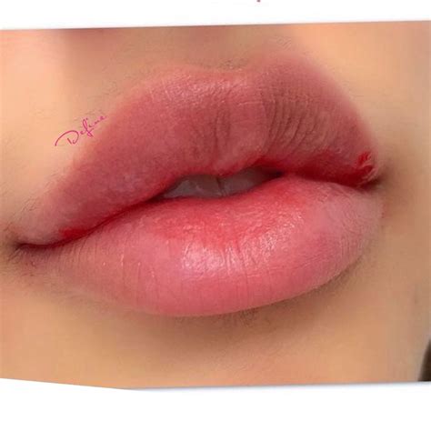 the perfect bow shaped lip 🎀 botox lips lips inspiration lip surgery