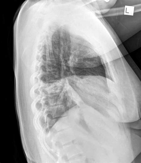 Chest X Ray Projection Chest X Ray MedSchool