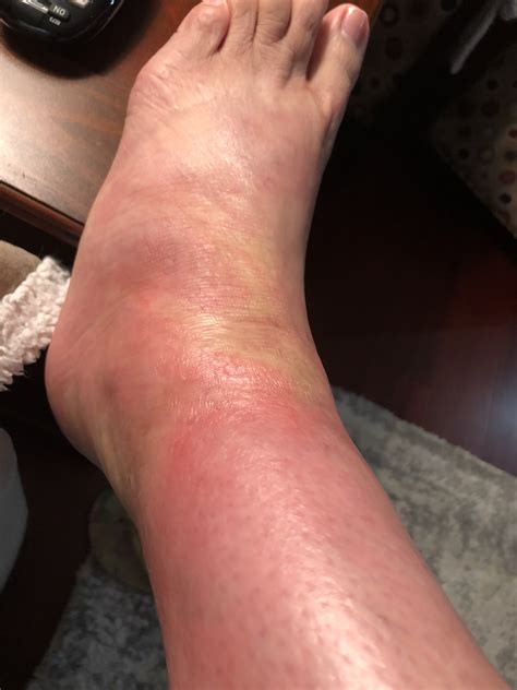 Swollen Feet With Rash