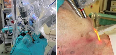Transoral Robotic Assisted Thyroidectomy With Central Neck Dissection