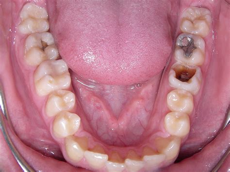 Die karies ist eine multifaktorielle erkrankung der zahnhartsubstanz, die unbehandelt die struktur und funktion der zähne zunehmend zerstört und zum zahnverlust führen kann. Karies: Loch im Zahn - Gute Gesunde Zähne