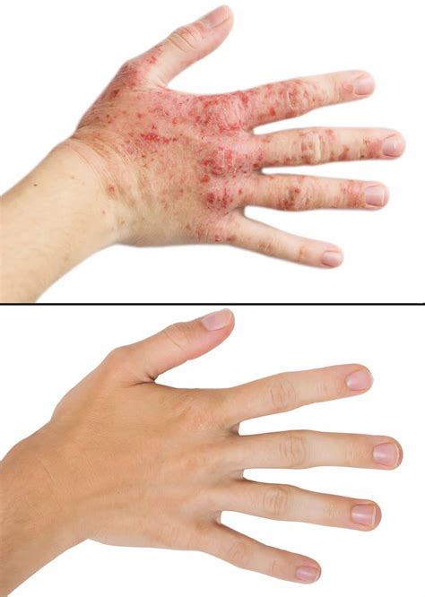 Eczema Landing Page A Permanent Cure Natural Therapy Naet Dubai