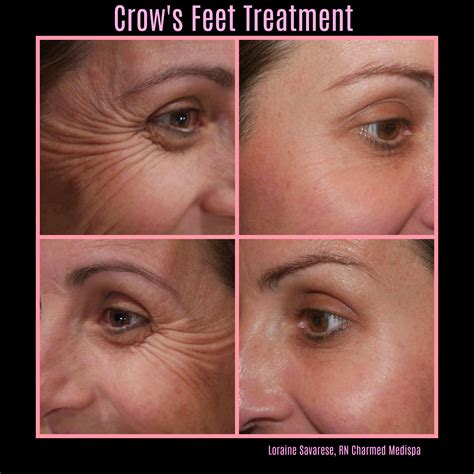 Azizzadeh can educate patients about botox for crow's feet and determine if they are good candidates for treatment. Ginormous Happiness - Charmed Medispa