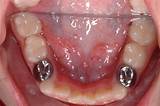 Silver Crowns Teeth Cost Images