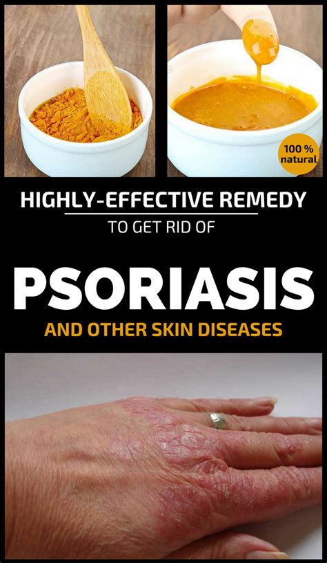Highly Effective Remedy To Get Rid Of Psoriasis And Other Skin Diseases
