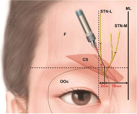 Guideline For The Injection Site Of Botulinum Toxin For Achieving