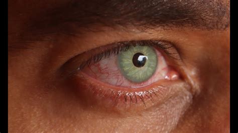 Cirugia Para Cambiar El Color De Ojos En Mexico Consejos Ojos