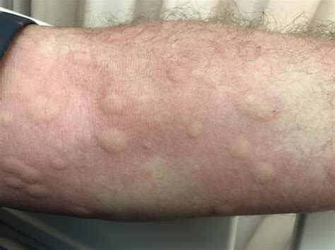 Urticaria Rashes