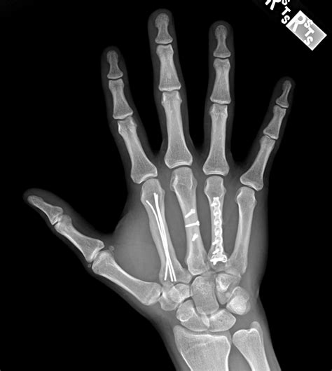 Metacarpal Fractures Orthopaedia Hand