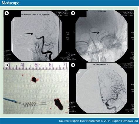 Revascularization For Acute Ischemic Stroke Treatment Page 12