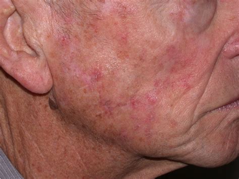 Acd A Z Of Skin Actinic Keratoses