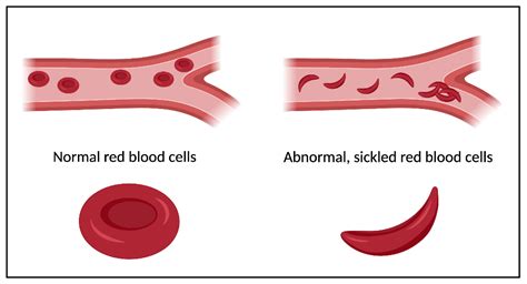 Gene Therapy For Sickle Cell Disease Shows Promise Hudsonalpha