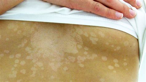 Tinea Versicolor Causes Symptoms Treatment Drugs Details