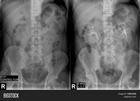 Intravenous Pyelogram Radiology Image And Photo Bigstock