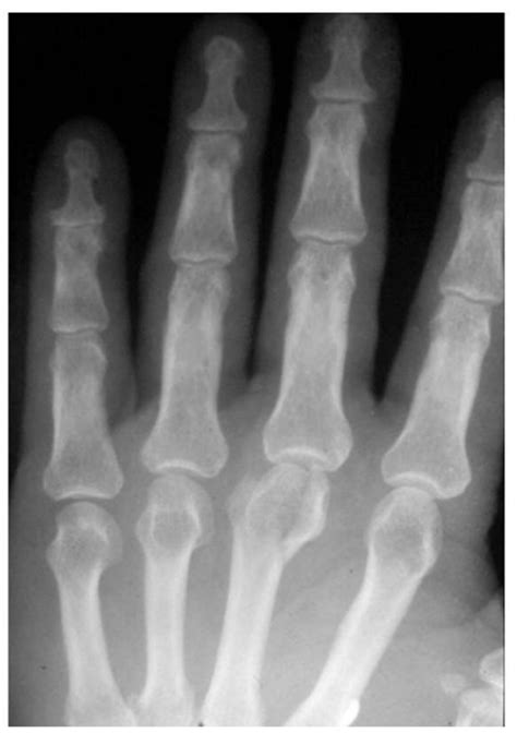 Metacarpal Fractures Core Em