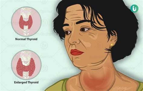 Goiter Symptoms Causes Treatment Medicine Prevention Diagnosis