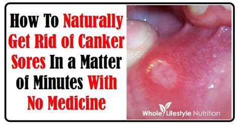 How To Heal A Canker Sore Fast The Homestead Survival