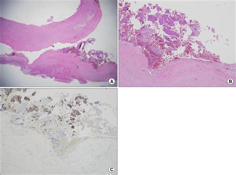 Histopathological Examination Of The Cyst Revealed No Epithelial Lining