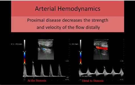 Lower Extremity Arterial Doppler Lower Extremity Vascular Ultrasound