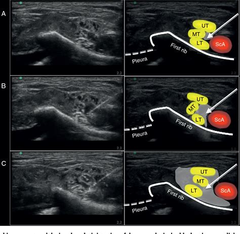 Figure 1 From Ultrasound Guided Supraclavicular Perivascular Block