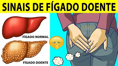 10 sinais de fÍgado doente youtube em 2020 remedios para o figado sinais gordura no figado