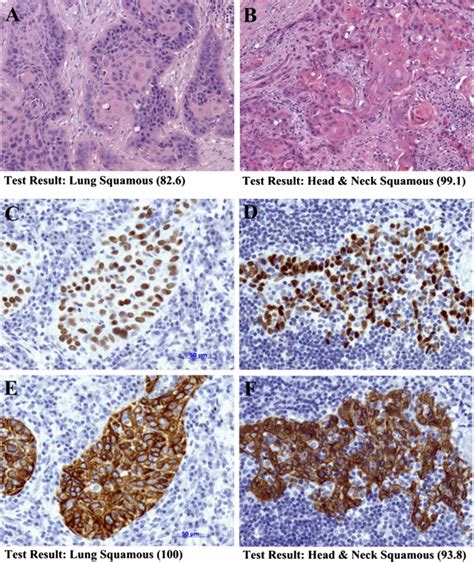 Distinction Of Head And Neck Squamous Cell Carcinoma Hnscc And Lung