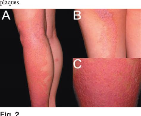 Figure From Acitretin Use In Epidermal Nevus Syndrome Semantic Scholar