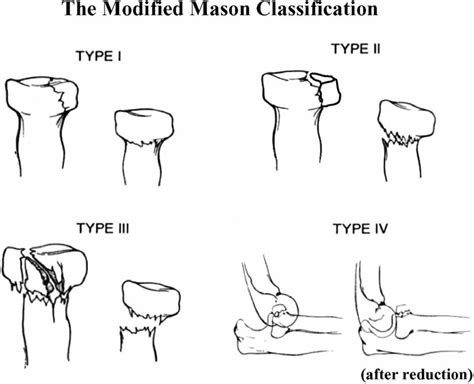 Radial Head Fracture Causes Types Symptoms Diagnosis Treatment