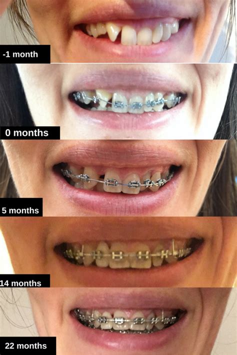 Braces At 30 15th Tightening 23 Months Before And After Photos