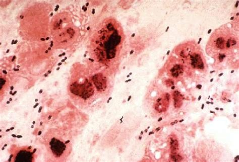 Streptococcus pneumonia is gram stain positive. Duke Pathology - Week 2: Inflammation