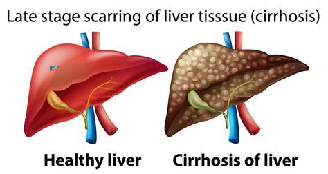 Liver Cirrhosis Treatment Liver Transplant Surgery Chennai Liver Foundation