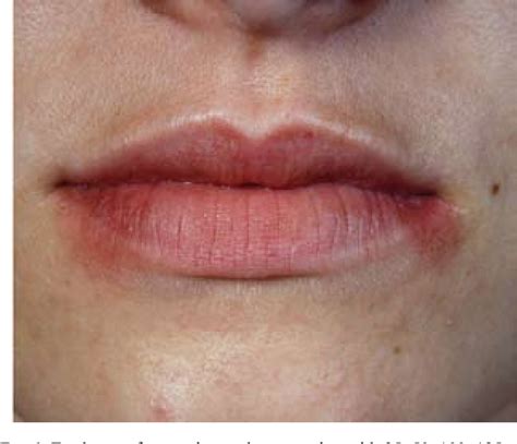 Figure 1 From A Young Woman With Recurrent Vesicles On The Lower Lip