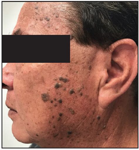 Home Remes For Seborrheic Keratosis On Face Tutorial Pics