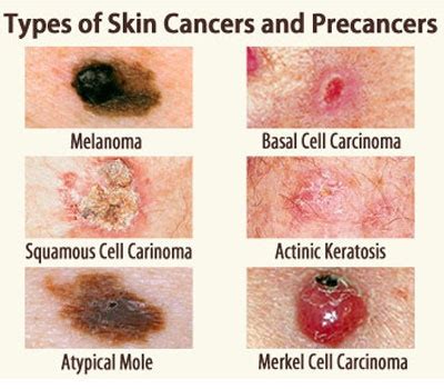 Skin cancers are one of the common cancers in the world population. What are the symptoms of skin cancer? - Quora