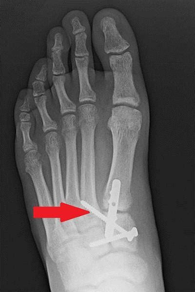 What Is Lisfranc Surgery Orthopedic Specialists Of Seattle