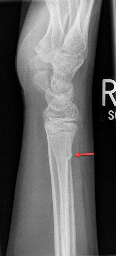 Torus Buckle Fracture Radiology For Beginners By Dr Med Samuel Kobba