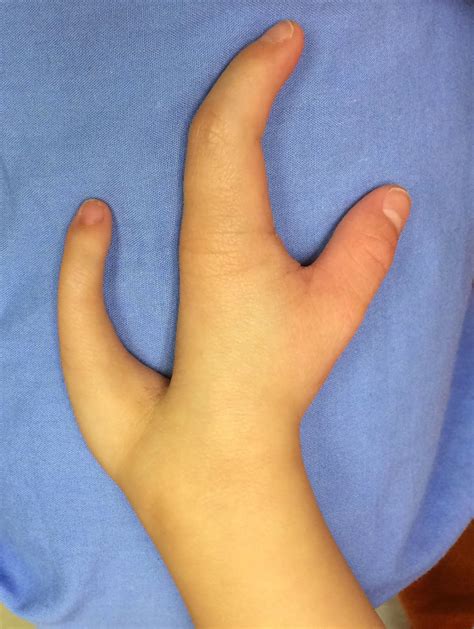 Ulnar Sided Cleft Hand Congenital Hand And Arm Differences